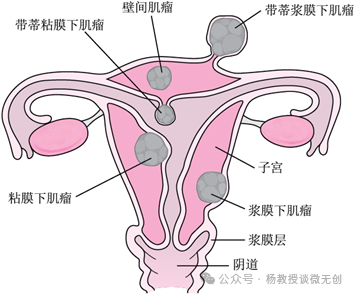 子宫肌瘤切不切，这次说明白了！