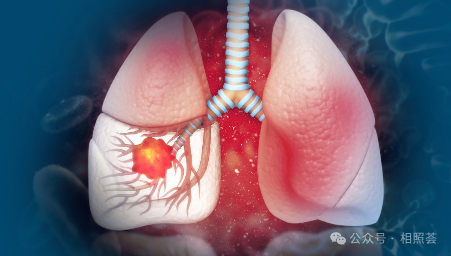 肺癌早期能完全治愈吗？用真实数据揭开真相！！