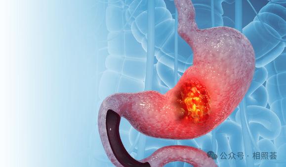 胃癌进展期怎么治？治愈可能性有多大？带你了解五大治疗手段效果！