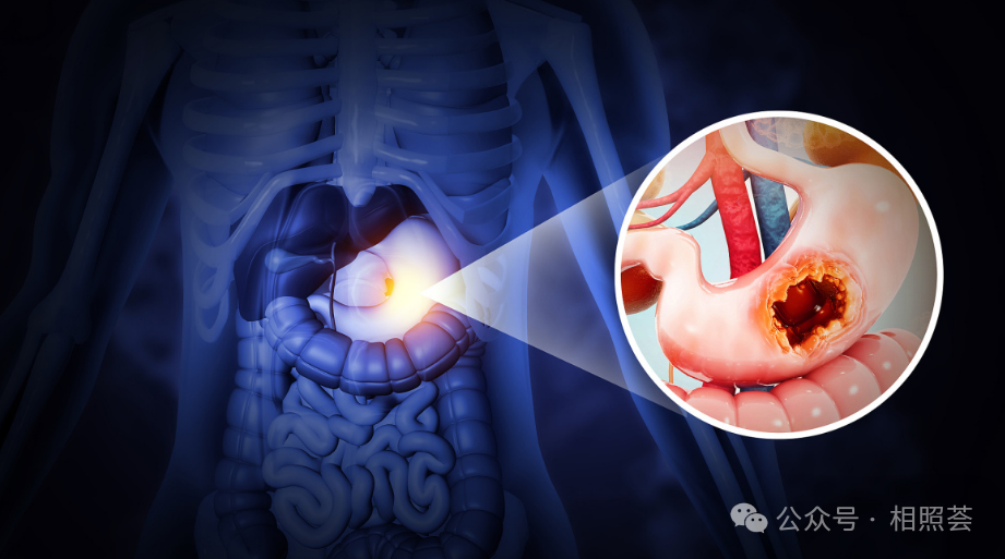 胃癌进展期怎么治？治愈可能性有多大？带你了解五大治疗手段效果！