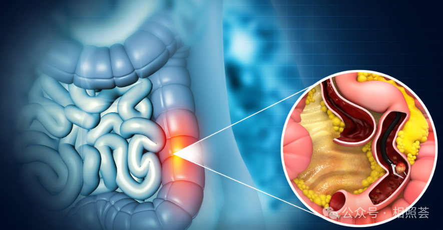 早发性“结直肠癌”偷袭年轻人，提前筛查是福是祸？