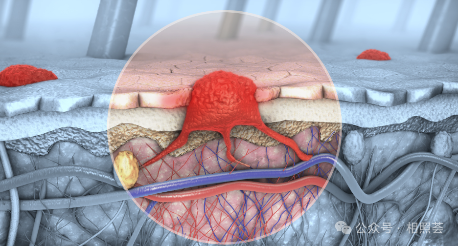 “肿瘤疫苗”时代来临？mRNA个性化治疗黑色素瘤有效率90%的真相揭秘！