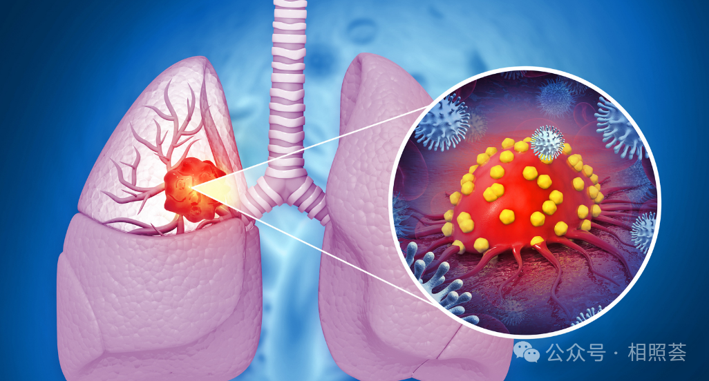 5年生存率提升40%？2025肺癌靶向药最新突破，这3类患者有救了！
