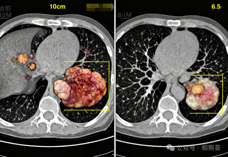 【TCR-T治疗案例分享】从&ldquo;判刑3个月&rdquo;到&ldquo;带瘤生存&rdquo;：肝癌父亲用TCR-T争取了5年！