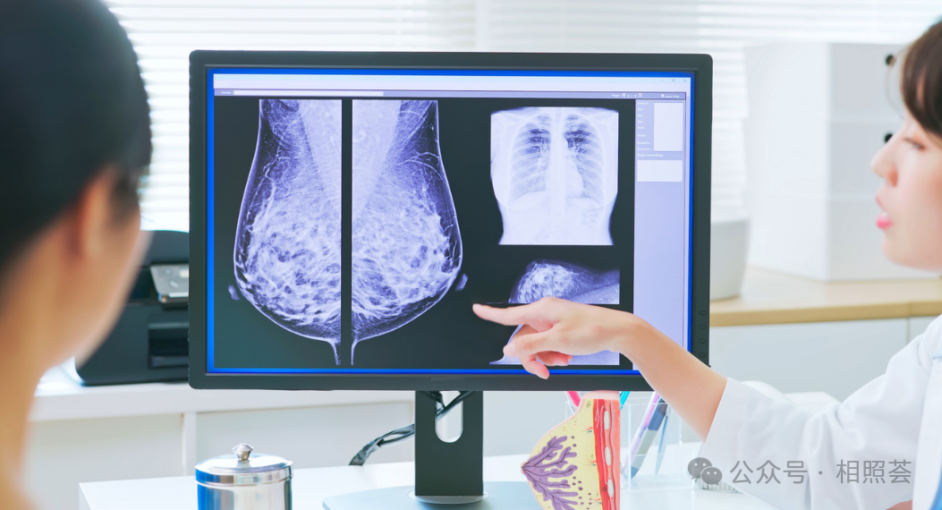 【Tcm细胞疗法案例分享】乳腺癌术后防复发的「隐形盾牌」&mdash;&mdash;Tcm细胞如何清除残留癌细胞？