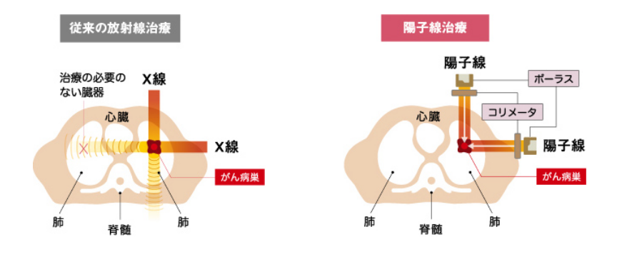 揭开质子治疗真相：精准&ne;零辐射，这个5类肿瘤需谨慎选择！