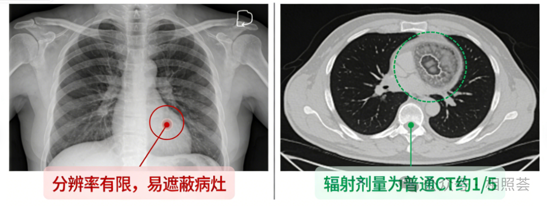 肺癌早筛：这5类人必须做低剂量CT，早期检出率已提升至62%！