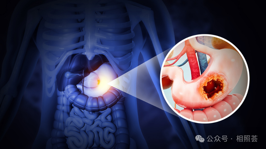 晚期胃癌&ldquo;免疫+靶向&rdquo;联合方案：信迪利单抗+雷莫西尤单抗，中位生存期突破15个月！