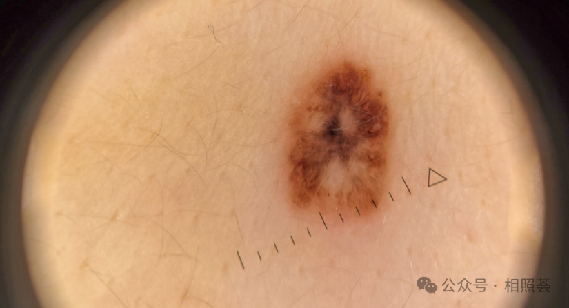 黑色素瘤&ldquo;从绝症到慢性病&rdquo;：靶向+免疫+TIL疗法，晚期患者生存期超10年！